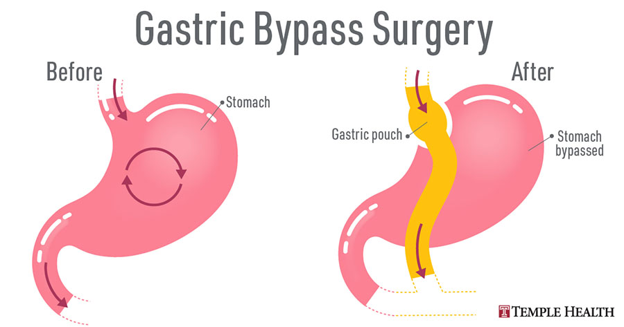 Laparoscopic Roux-en-Y Gastric Bypass