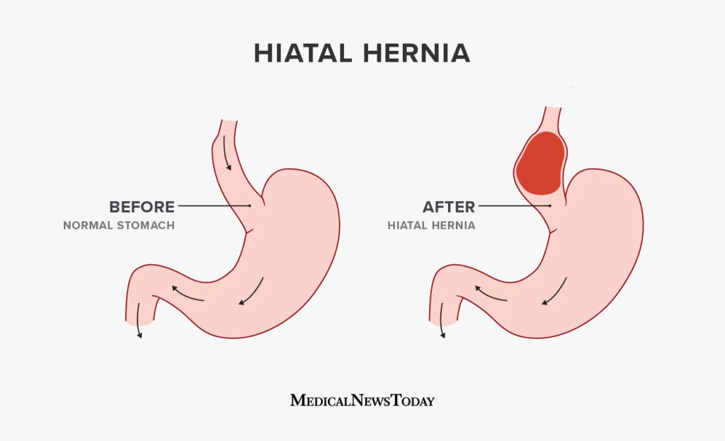 Laparoscopic Hiatal Hernia Repair with Fundoplication