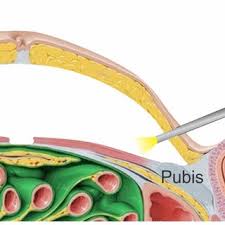 SCOLA (Subcutaneous Onlay Laparoscopic Approach) for Ventral Hernia Repair and Diastasis Recti